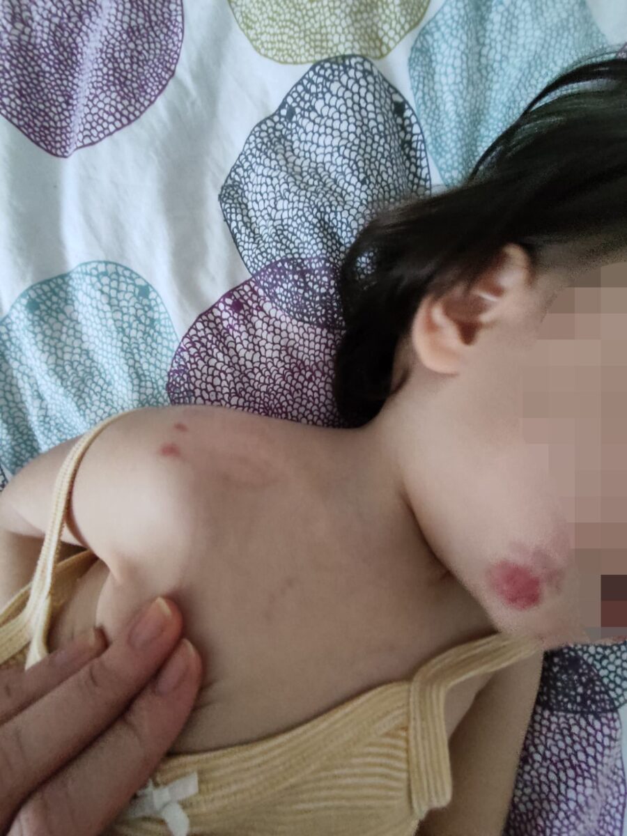 Dijete u sarajevskom vrtiću zadobilo povrede na neutvrđen način: Policija sve istražuje, roditelji tvrde da vrtić sve “zataškava”