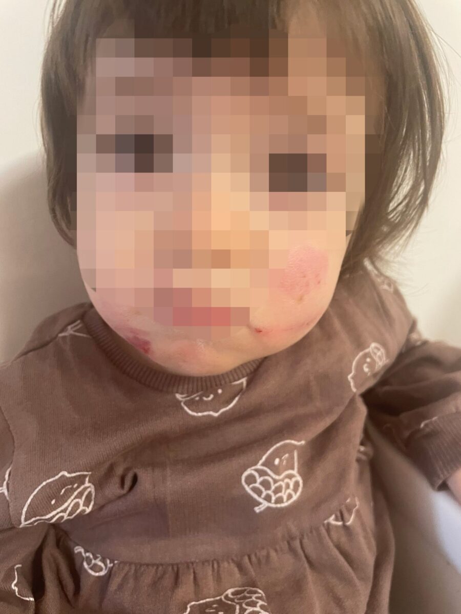 Dijete u sarajevskom vrtiću zadobilo povrede na neutvrđen način: Policija sve istražuje, roditelji tvrde da vrtić sve “zataškava”