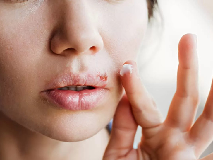 Herpes na usnama ne mora trajati danima: Evo šta zaista pomaže u roku od 24 sata