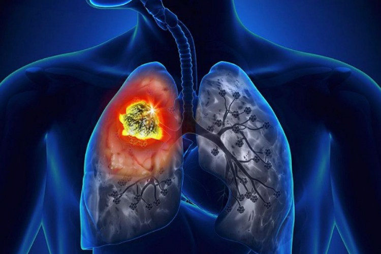 Sve više oboljelih od raka pluća u TK, zagađen vazduh jedan od glavnih uzroka