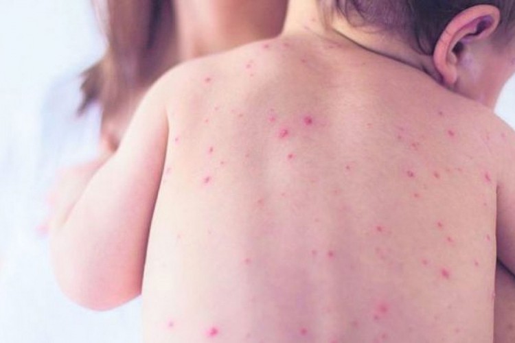 SZO: U Evropi neophodna hitna i ciljana vakcinacija protiv morbila