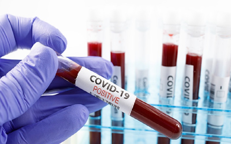 Još 129 osoba u Srpskoj pozitivno na virus korona