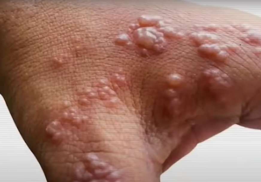 Epidemiolog objašnjava kakvi su simptomi kod majmunskih boginja i šta ne bi trebalo da radite