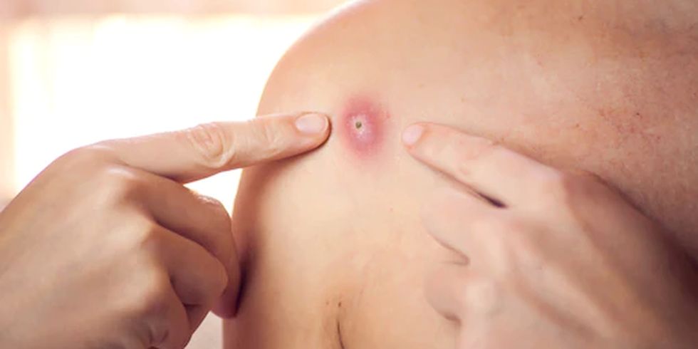 SZO o širenju majmunskih boginja: Širenje virusa se može obuzdati pravim mjerama