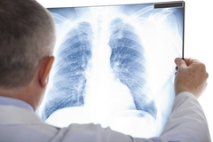 Od tuberkuloze za tri godine oboljelo 386 ljudi u Srpskoj