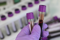 Na korona virus pozitivne još 72 osobe u Srpskoj, preminulo 13 zaraženih