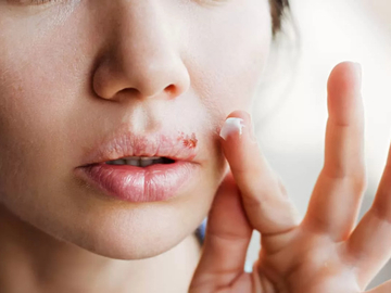 Herpes na usnama ne mora trajati danima: Evo šta zaista pomaže u roku od 24 sata