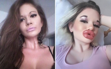 Ovo je djevojka s jednim od najvećih usana na svijetu