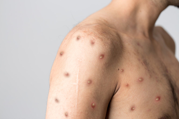 SZO: I dalje vanredna situacija zbog epidemije majmunskih boginja