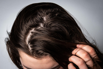 Kako prirodnim preparatima tretirati kosu koja se brzo masti