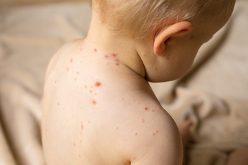 Institut: Nije isključena mogućnost epidemije morbila u Srpskoj