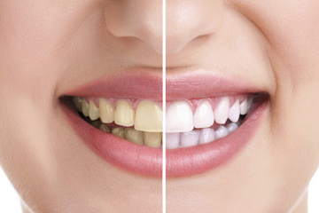 Kako izbijeliti zube na prirodan način
