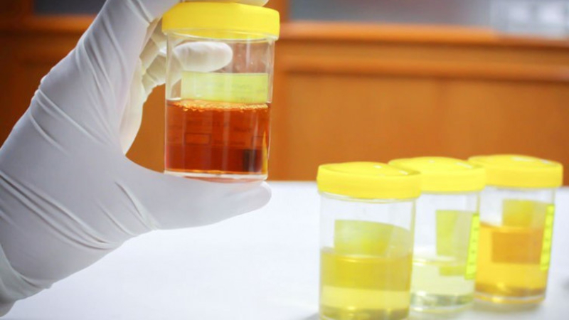 Ljekari objasnili šta sve boja urina može da otkrije o vašem zdravlju